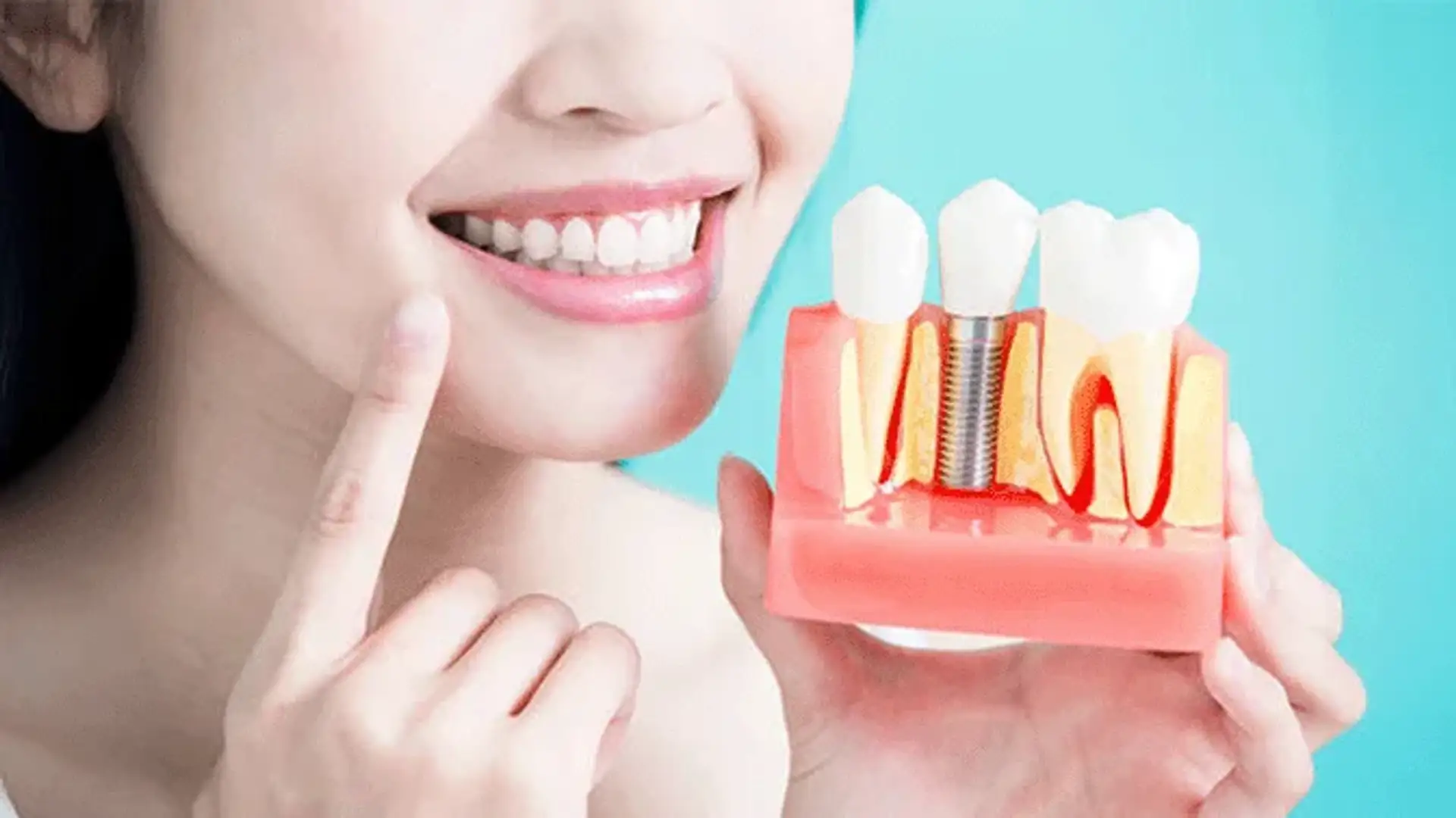was-ist-alles-auf-x-implantat