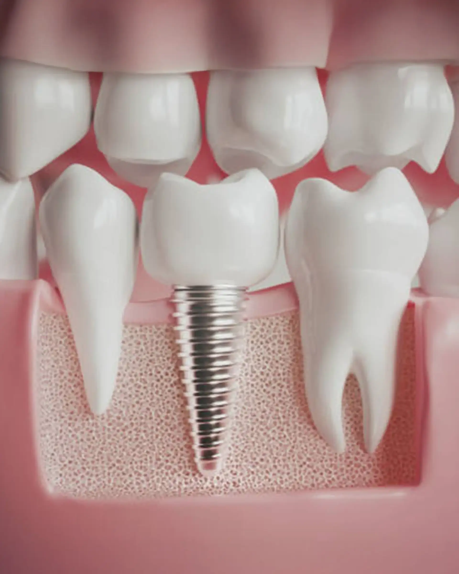 Implantat-Behandlung