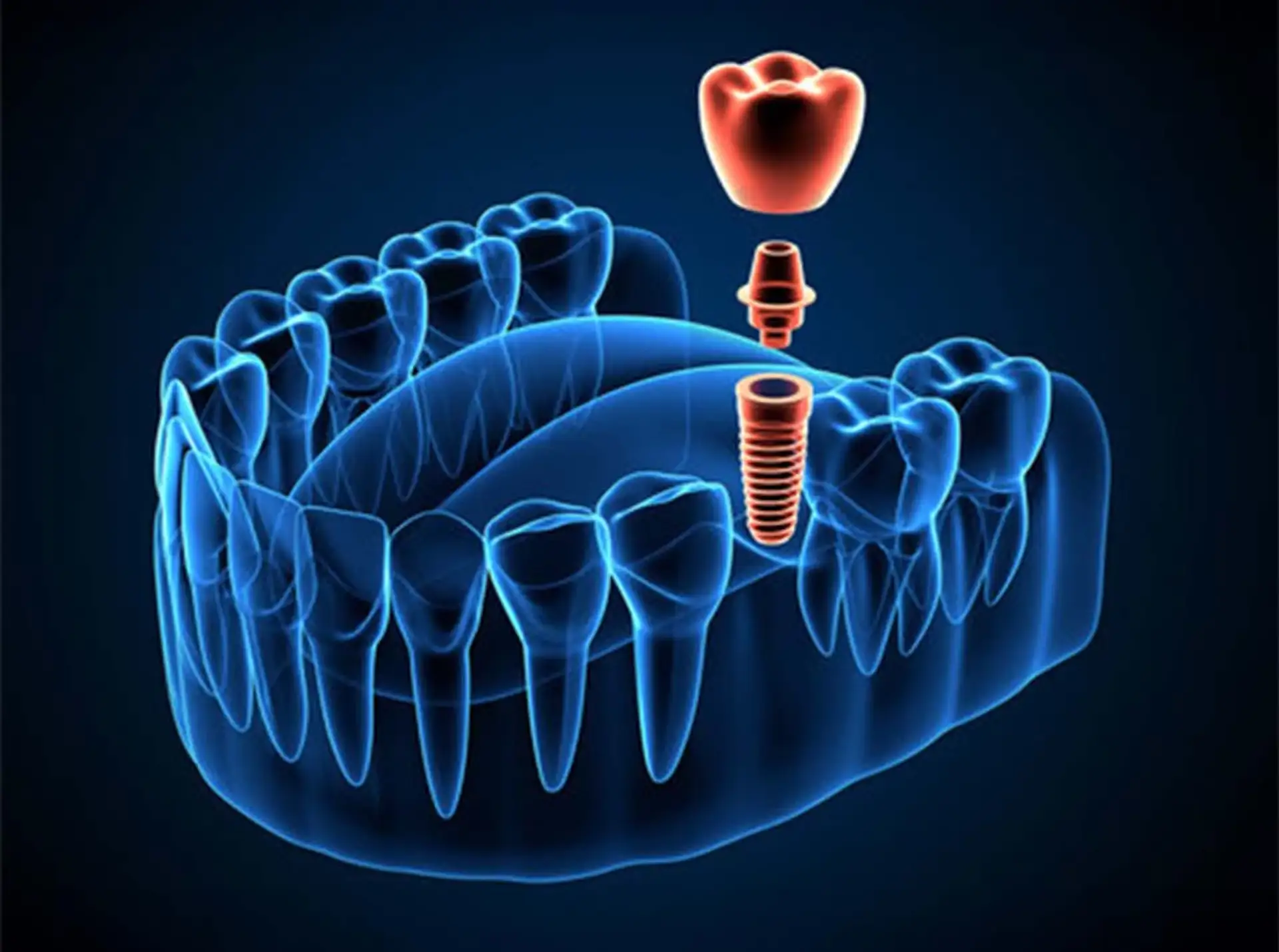 das-all-on-x-implantat
