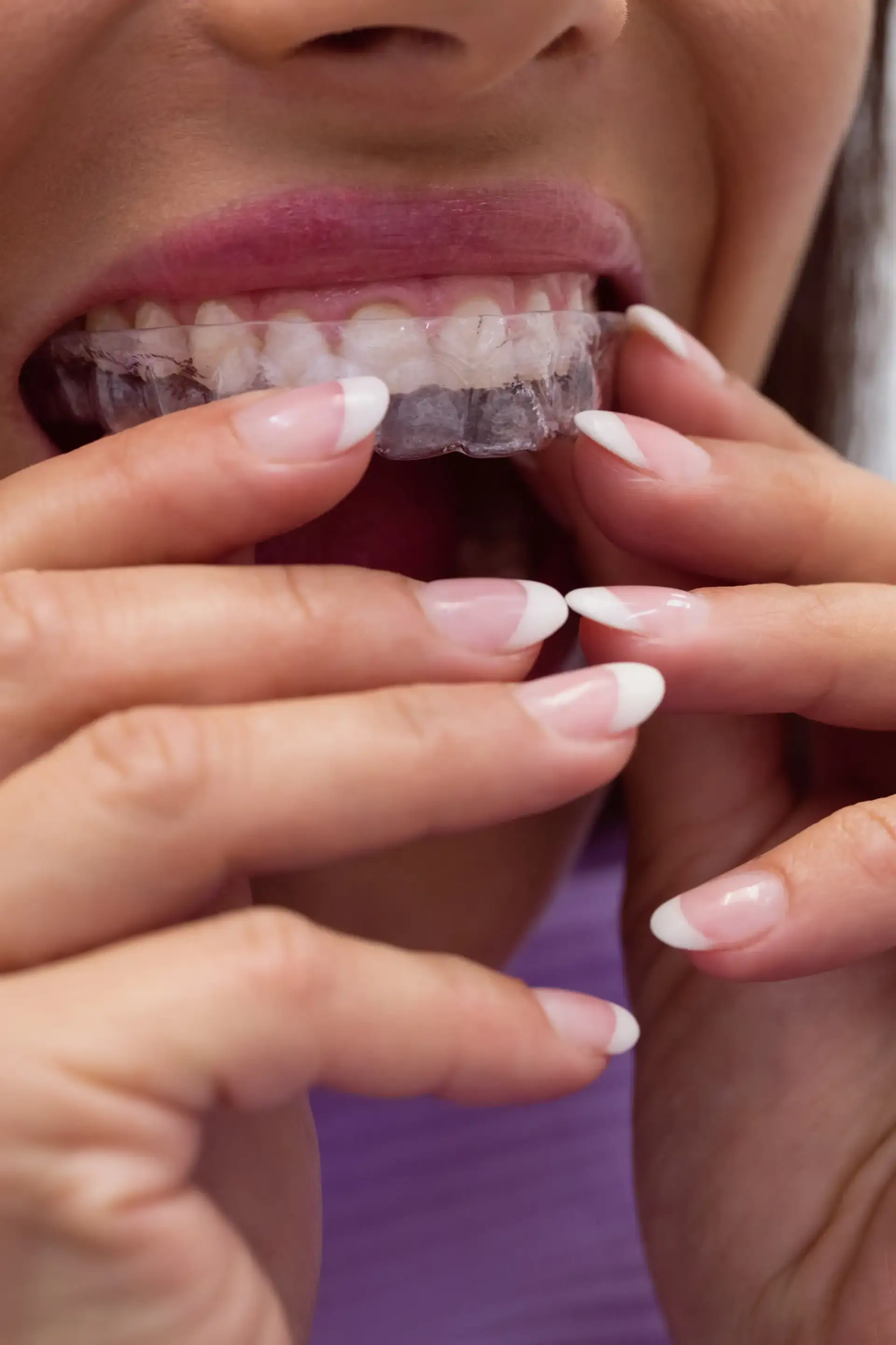 invisalign-in-istanbul