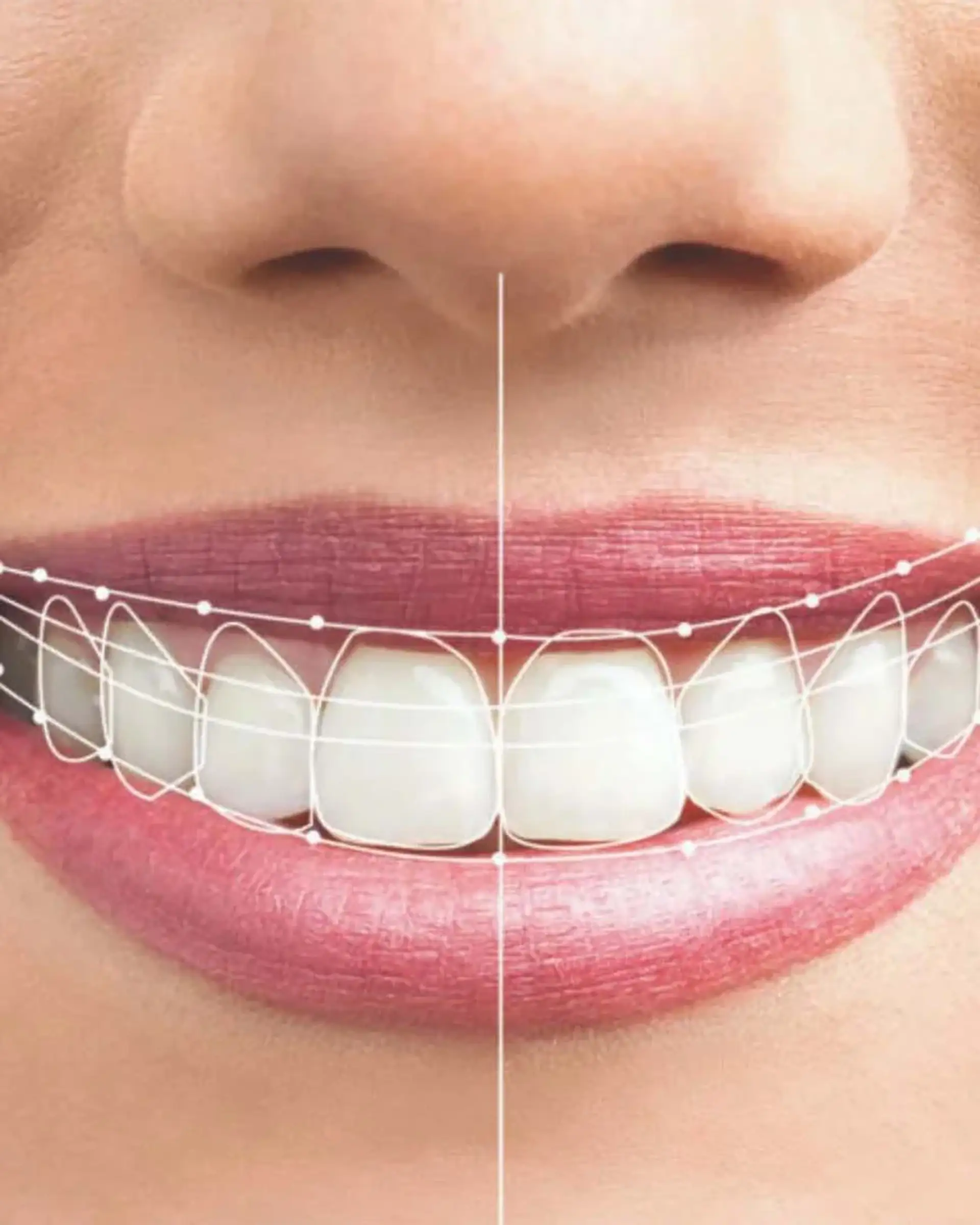 ic-dental-hollywood-smile