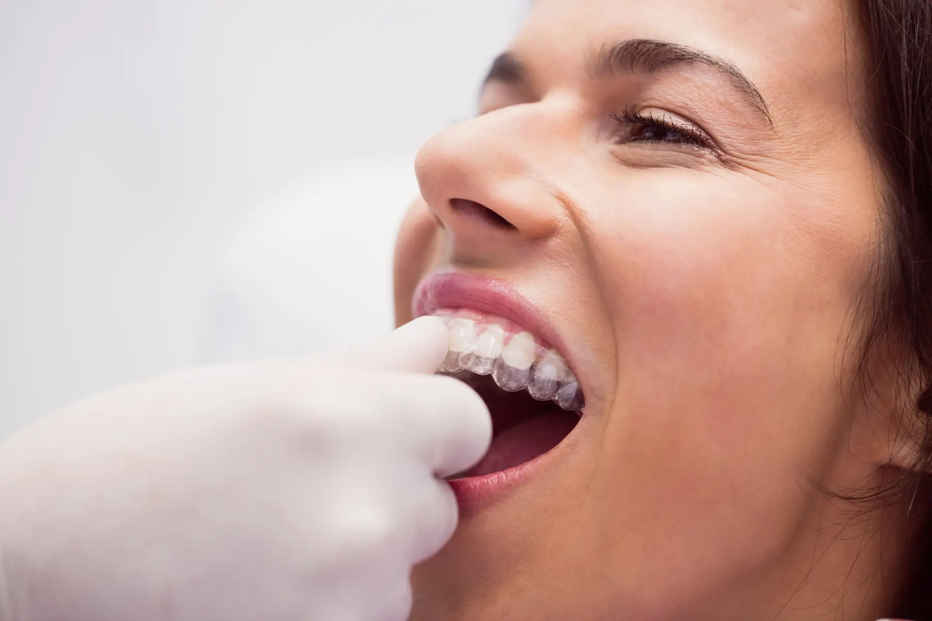 clear-aligners