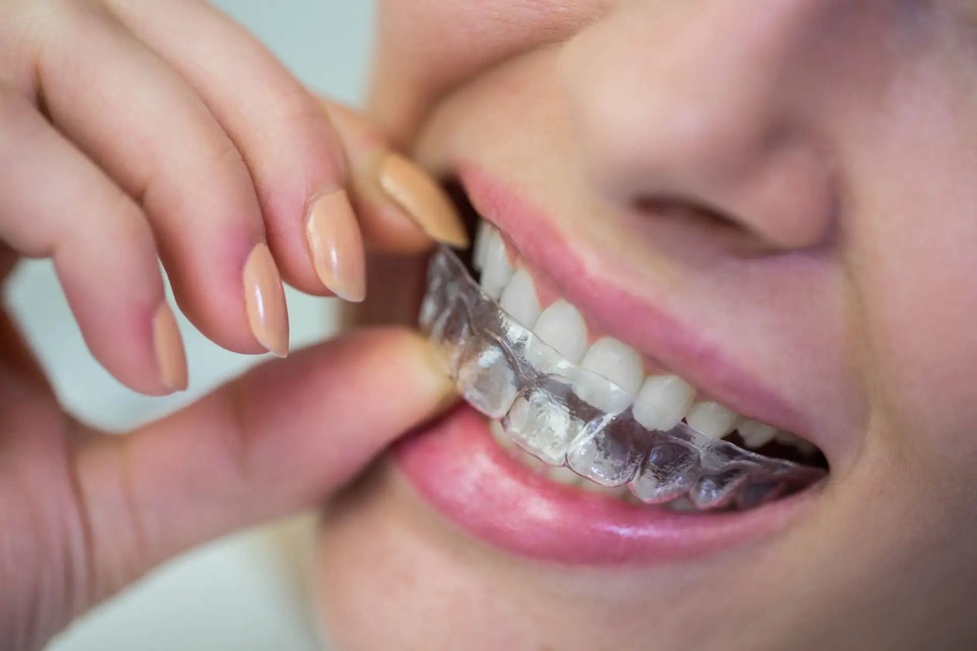 inman-clear-aligners