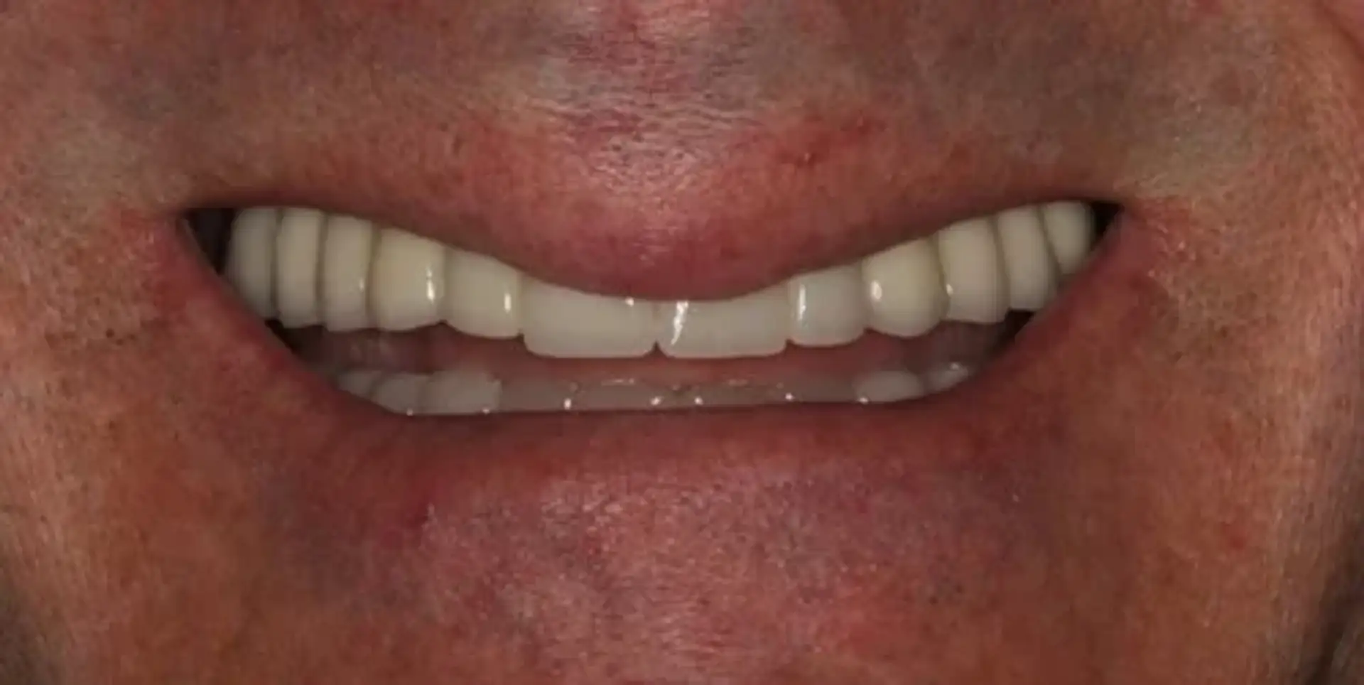 Dental Before and After: Real Smile Makeover Results