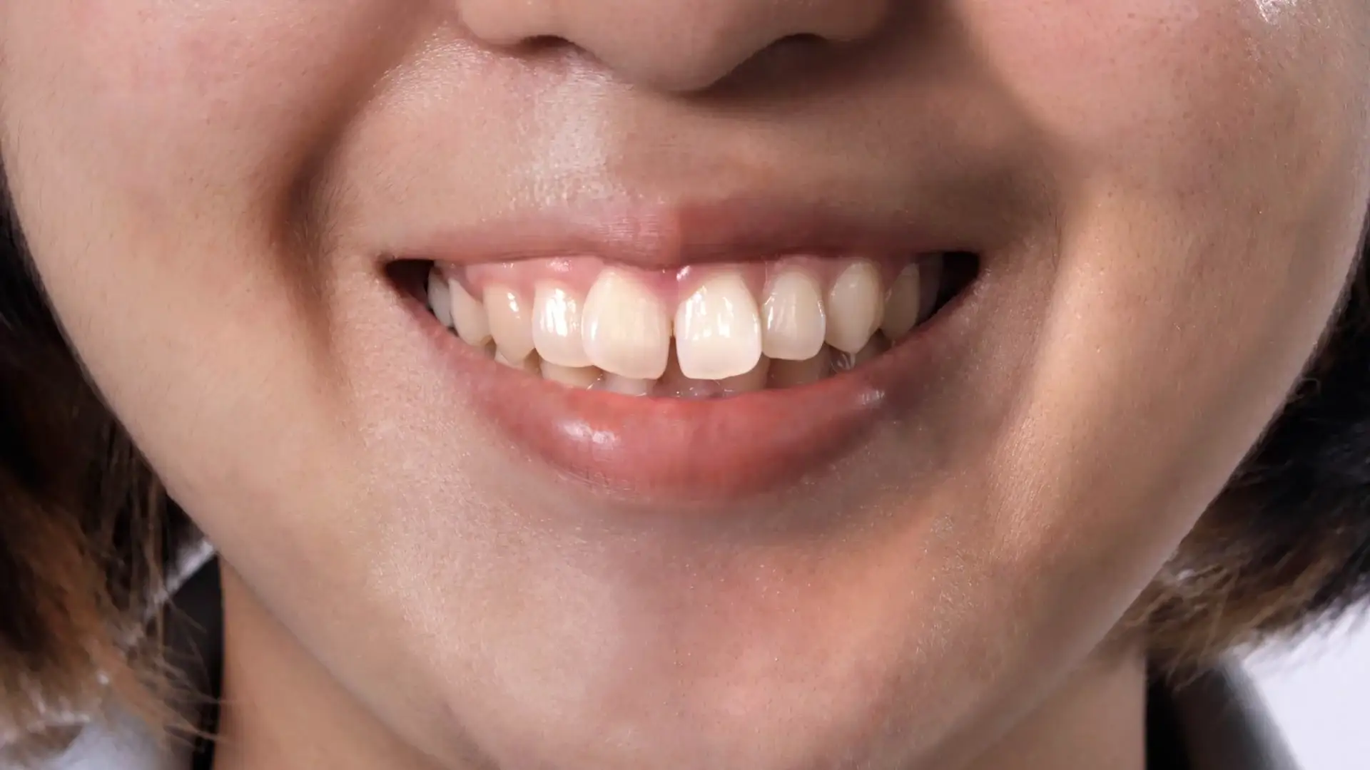 Buck Teeth: Treatment Options, Cost & Timeline