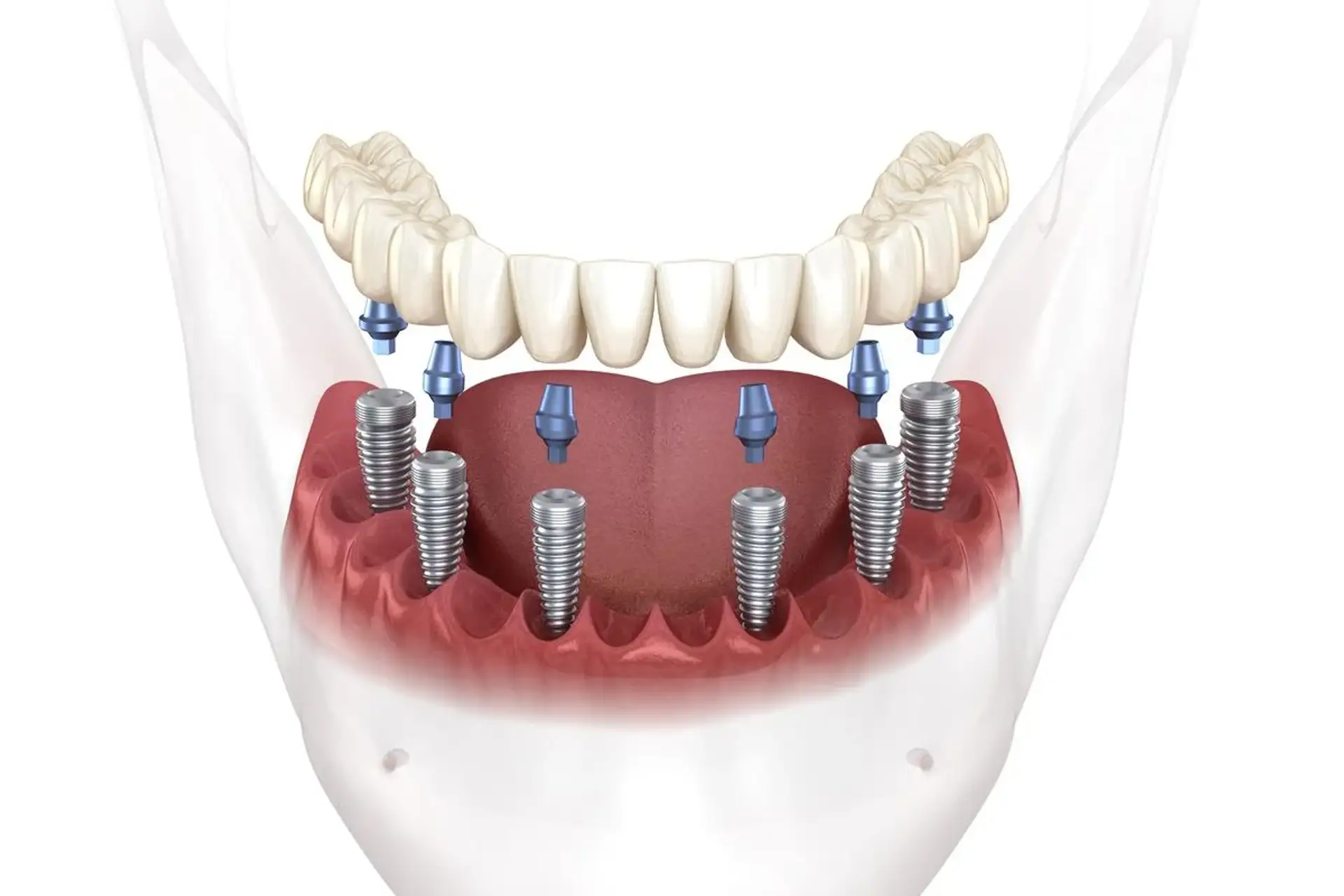 Zirconium Crowns in Turkey: Cost, Durability and Process