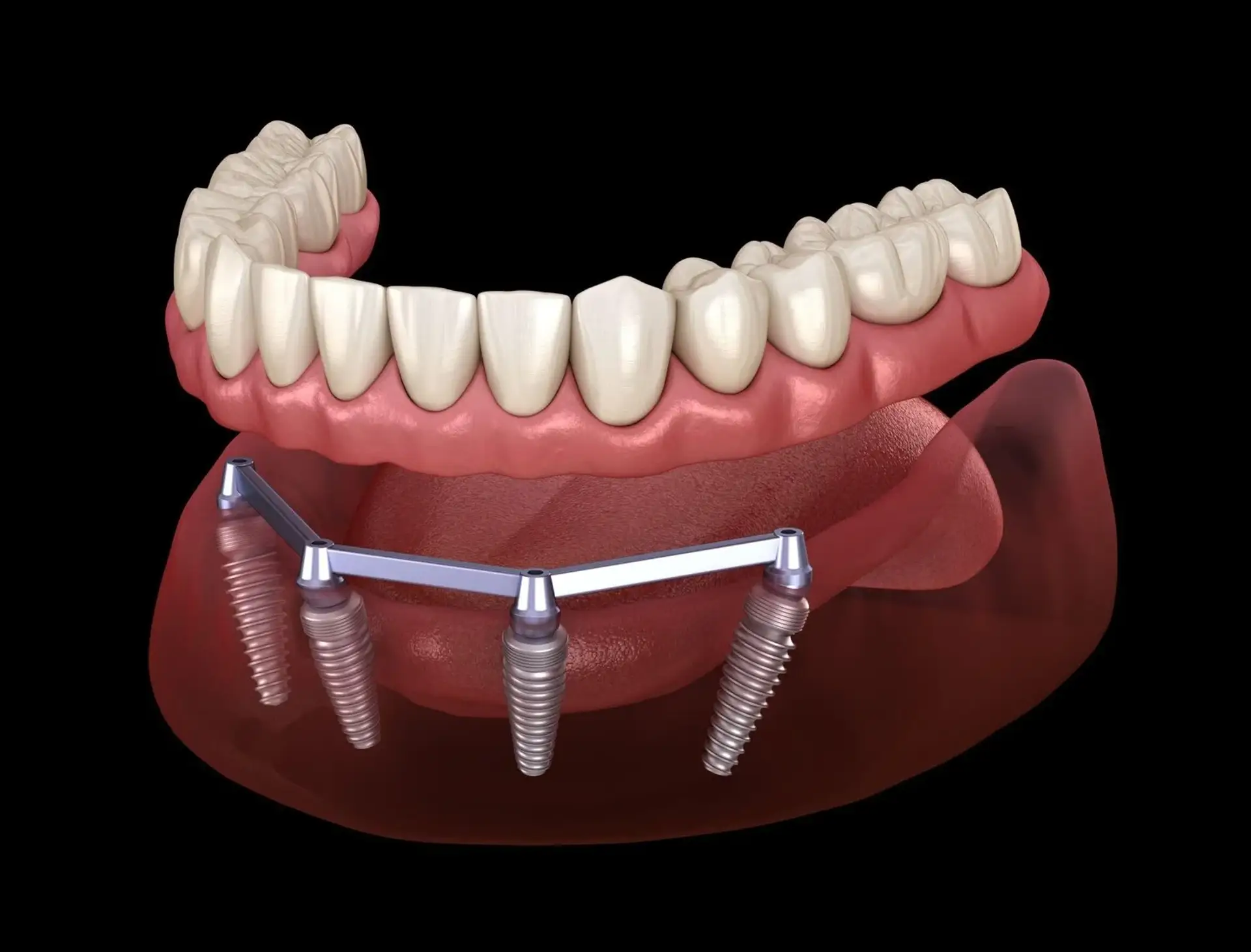 Dental Implants in Turkey: Cost Analysis