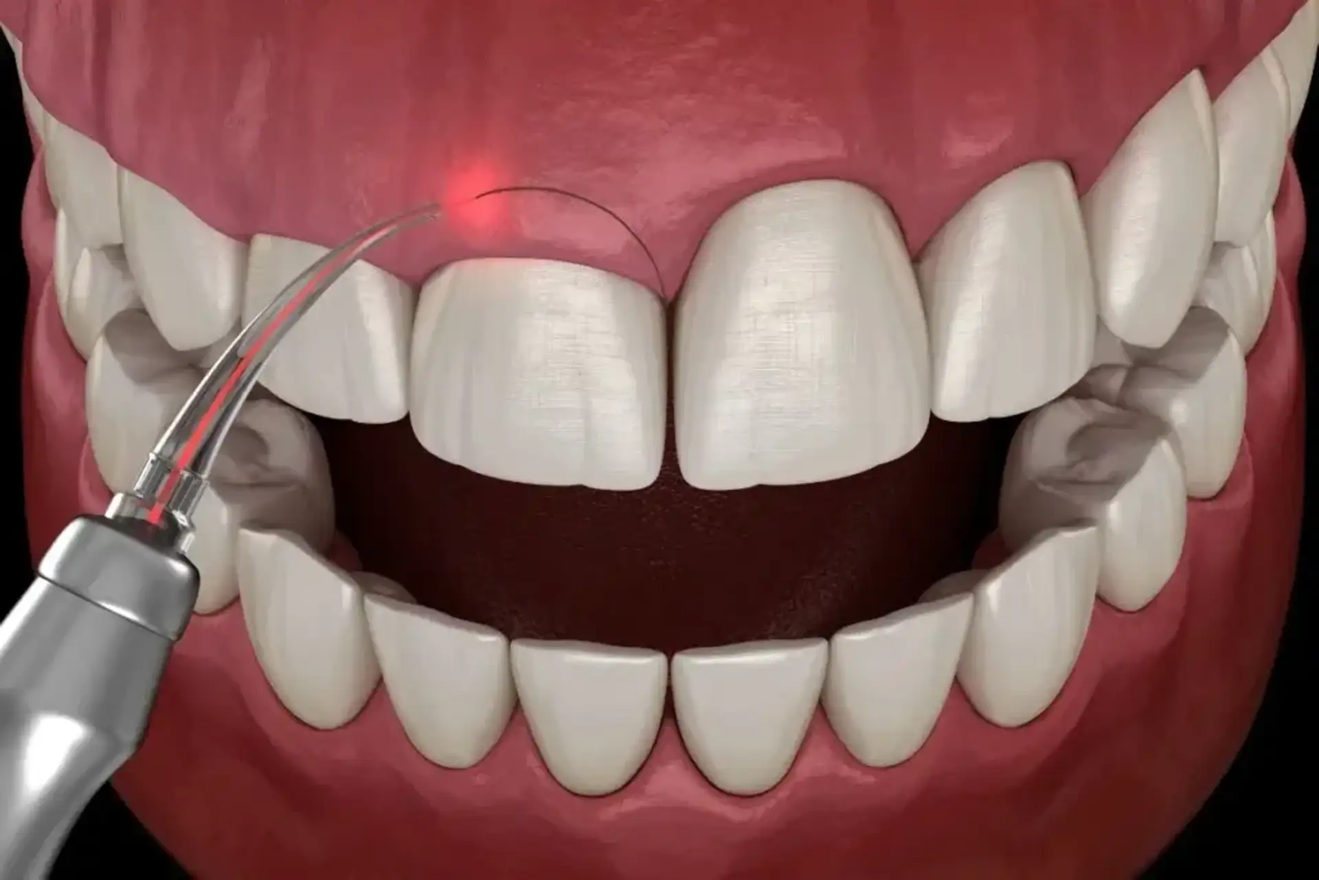 Fixing Gum Recession: Professional Methods