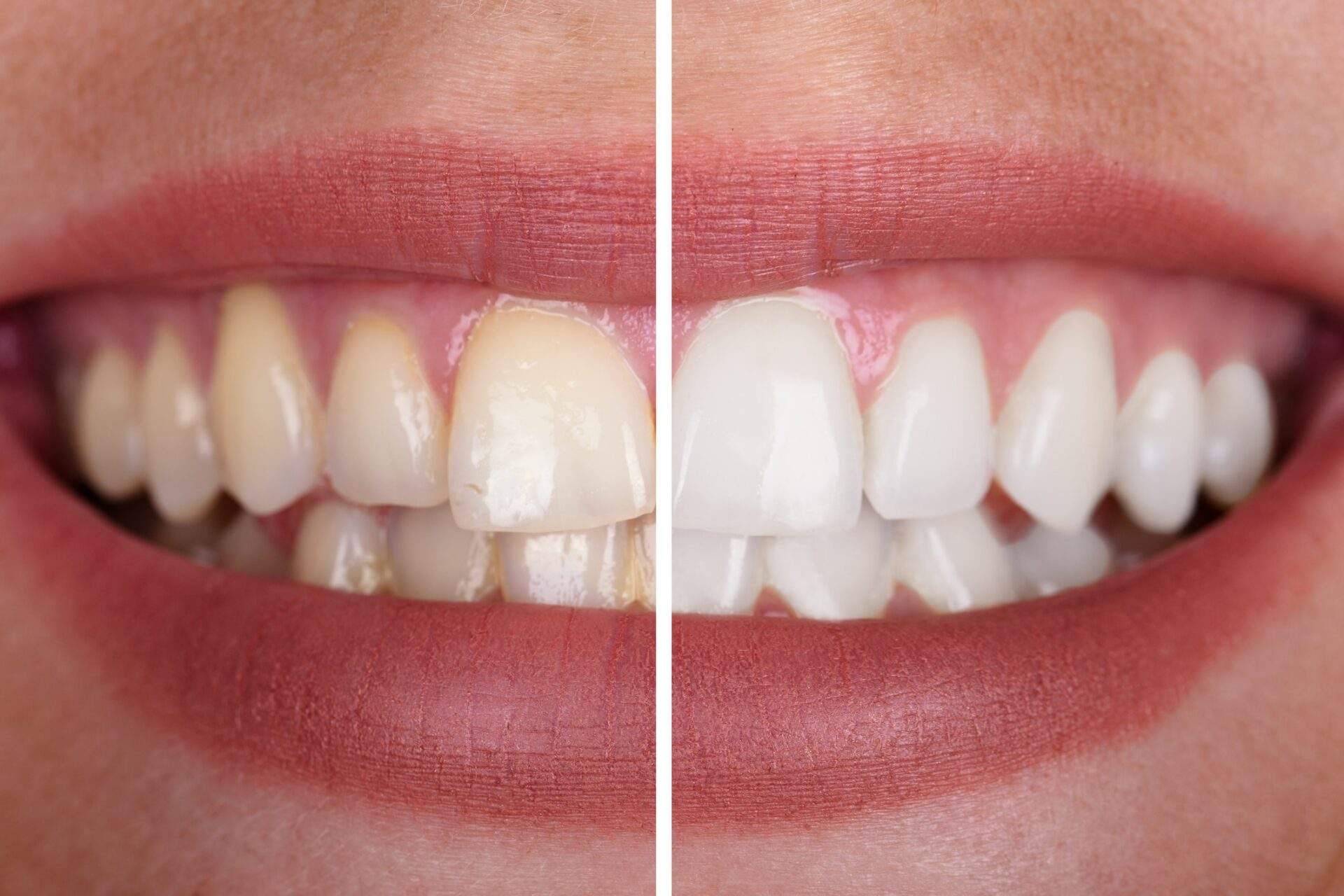 How to Whiten Teeth- Evidence-Based Methods