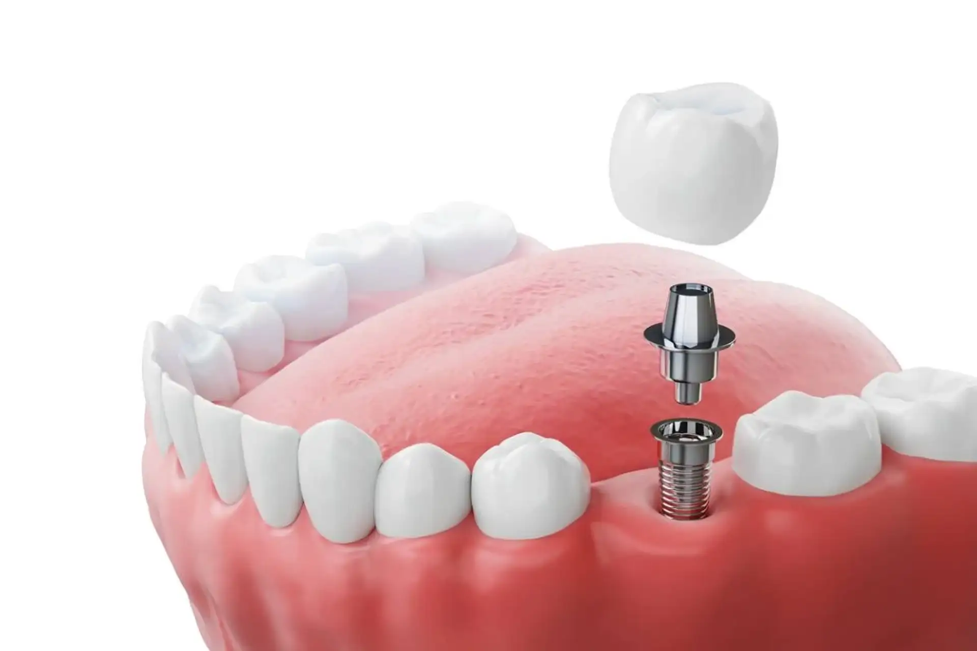 Screwless Dental Implants: Cost & Procedure Overview