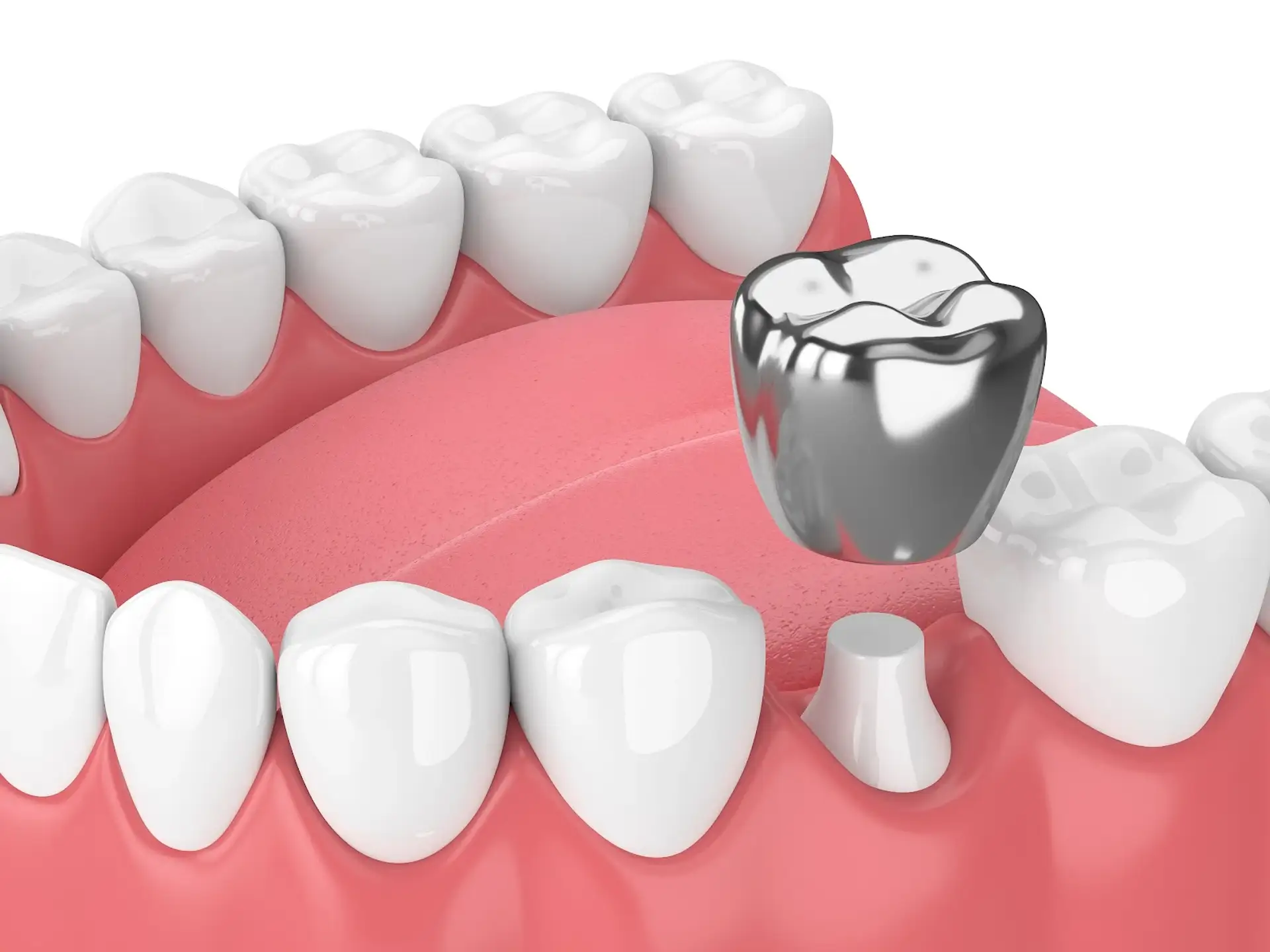 Silver Tooth Cap: A Professional Overview