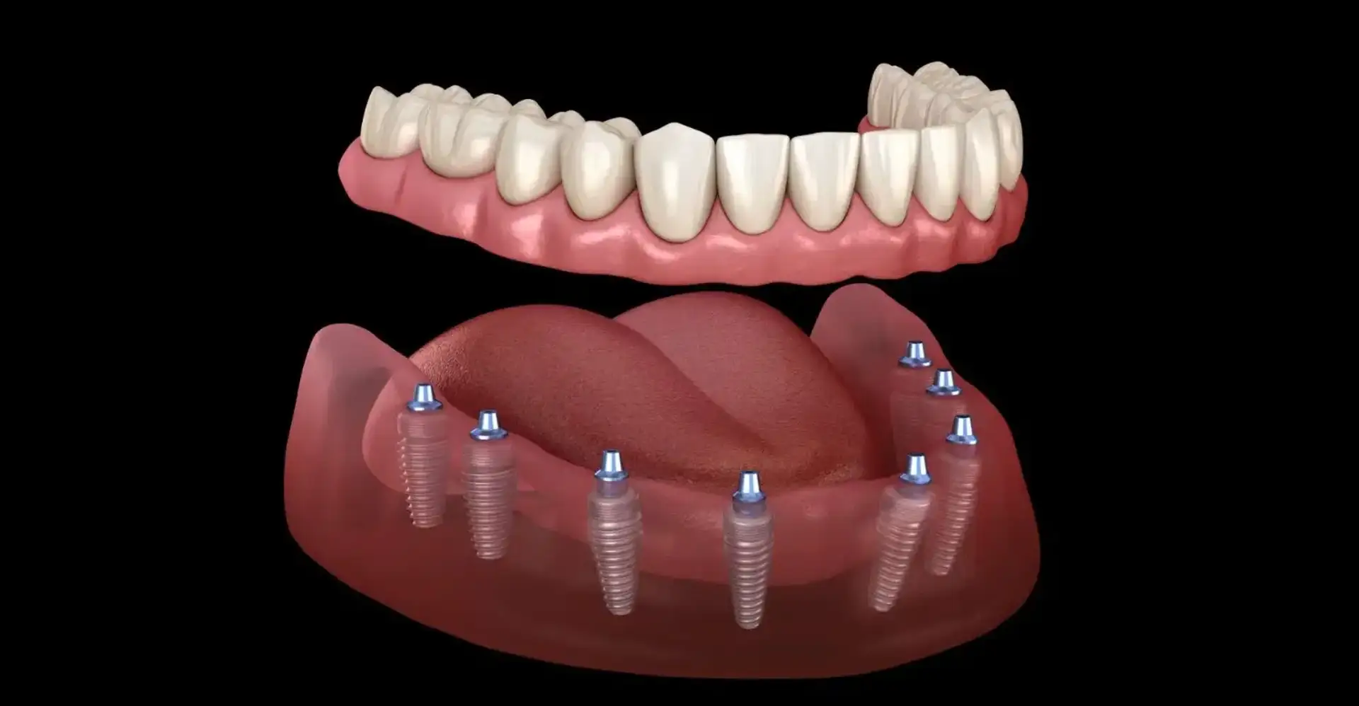 Tooth Bridge Types, Costs & Lifespan: Clinical Overview