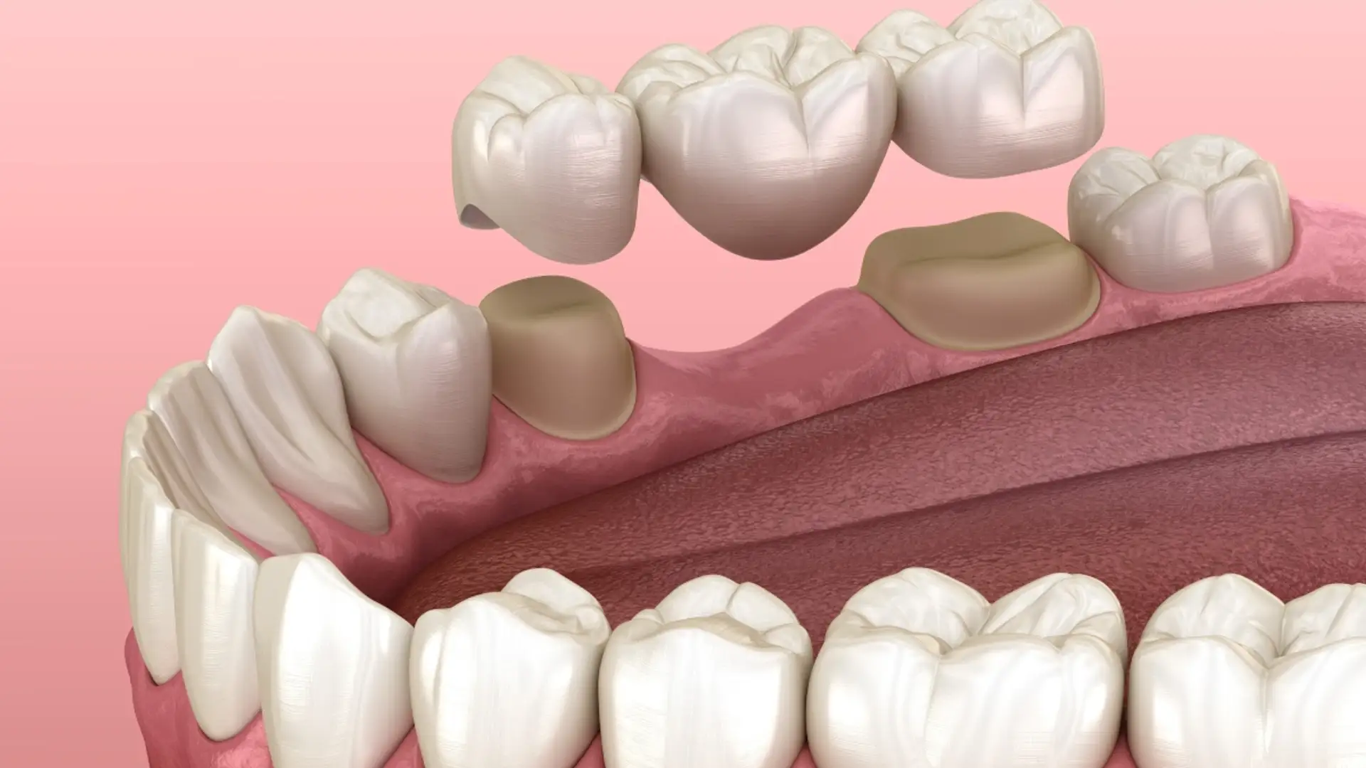 Tooth Bridge Types