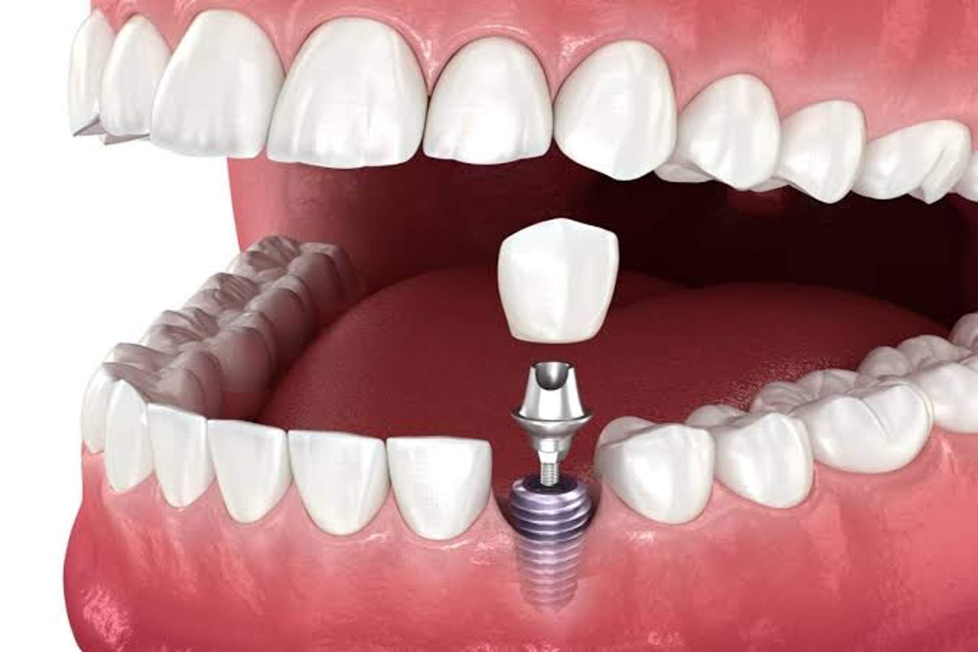 What to Expect During Your Dental Implant Procedure