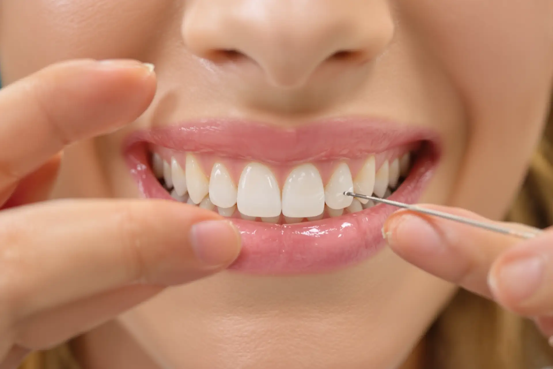 How Long Do Veneers Last? Up to 15 Years