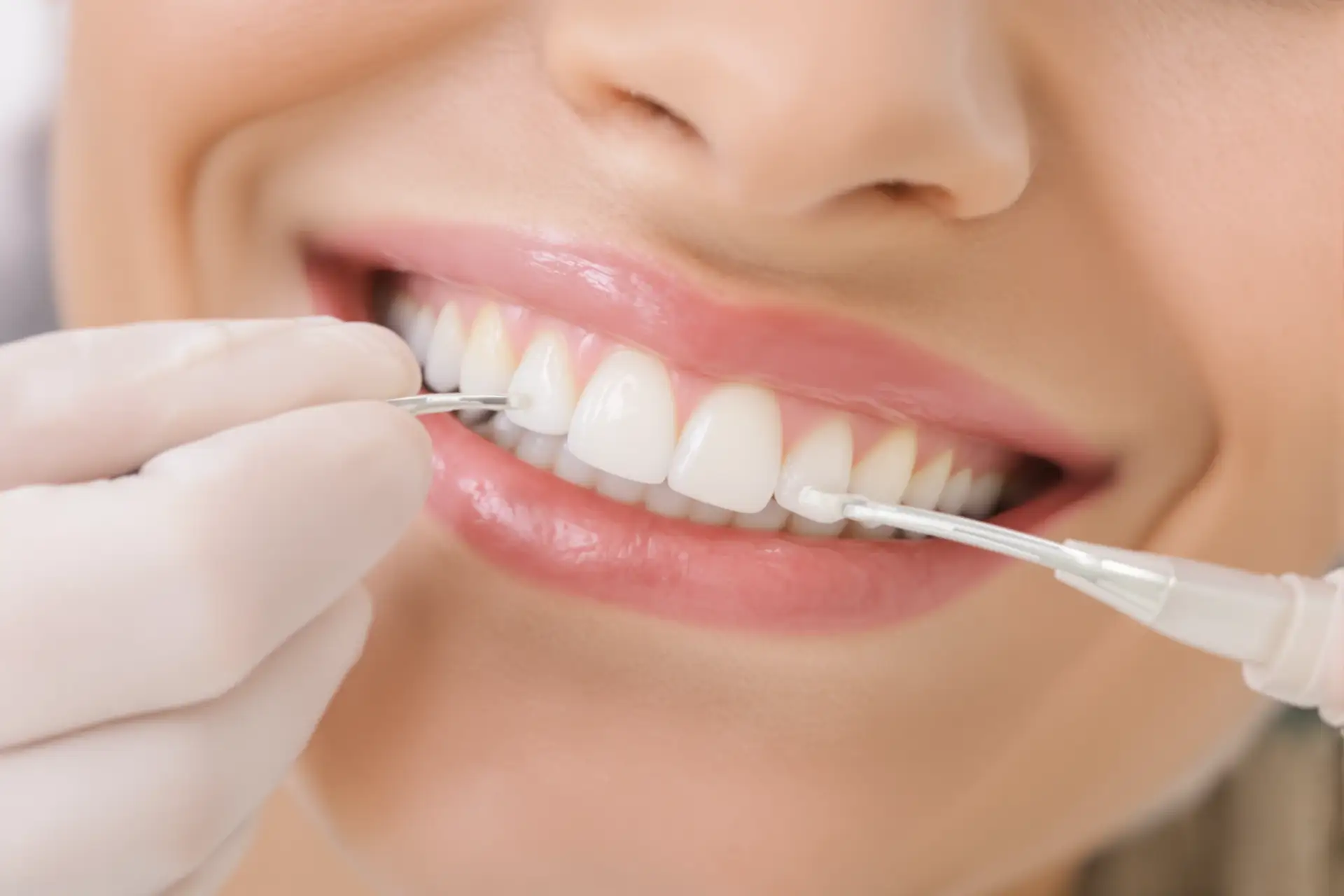 Snap On Veneers vs Permanent: Cost & Look Compared