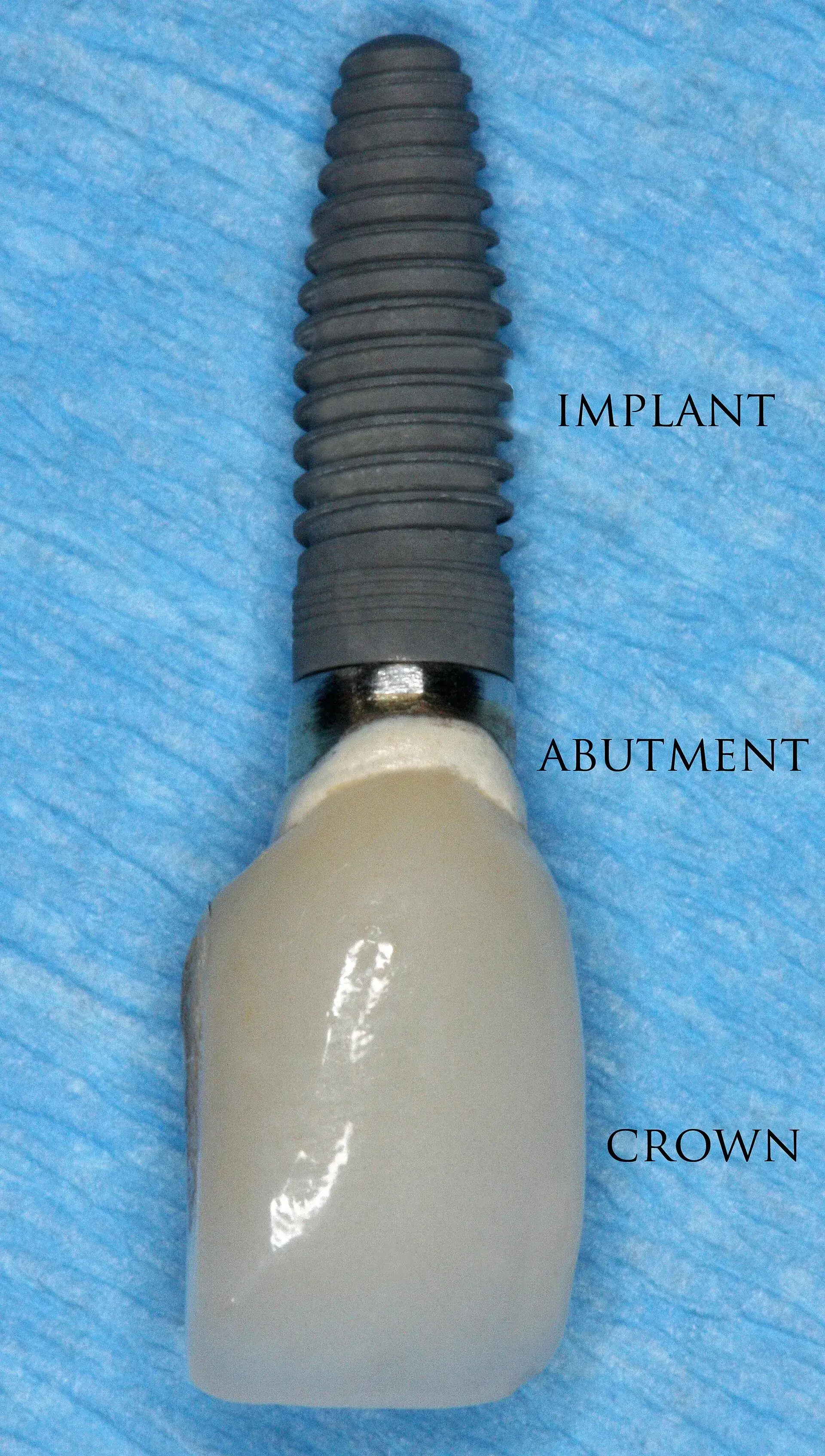 Celebrity Dental Implants