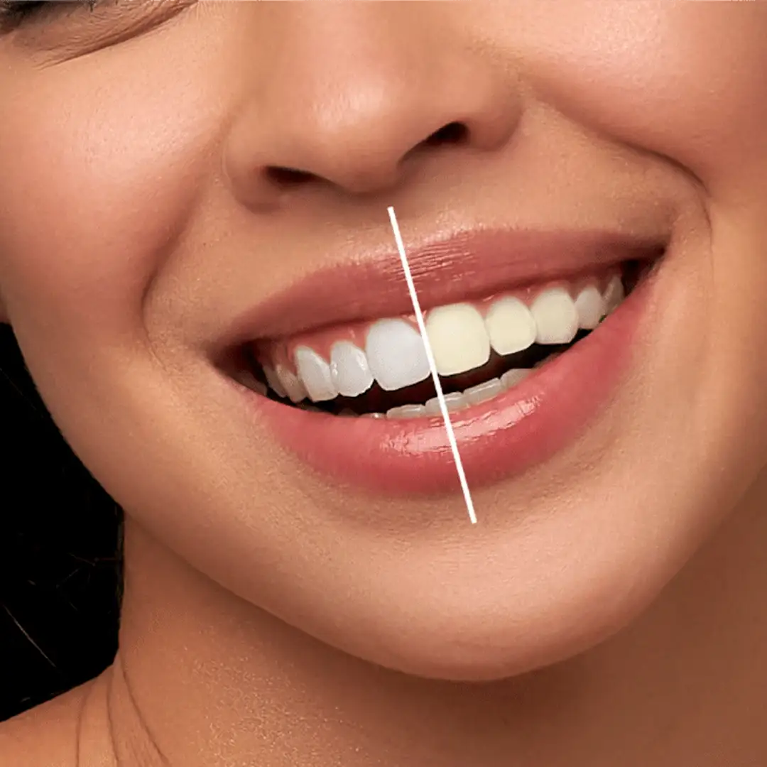 what-is-teeth-whitening