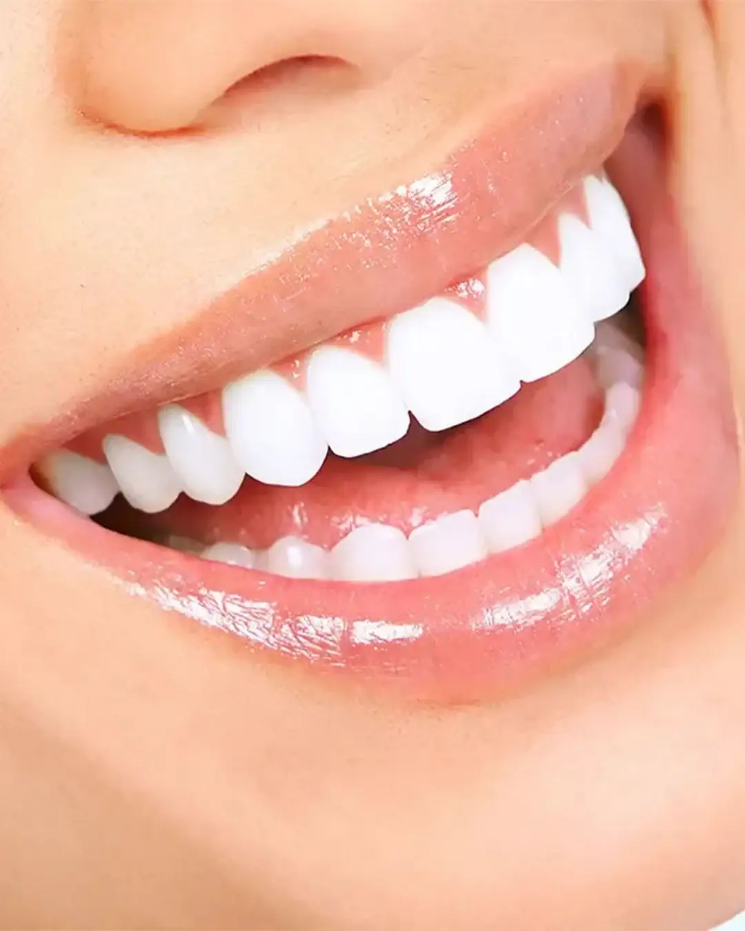 veneer-treatment-process