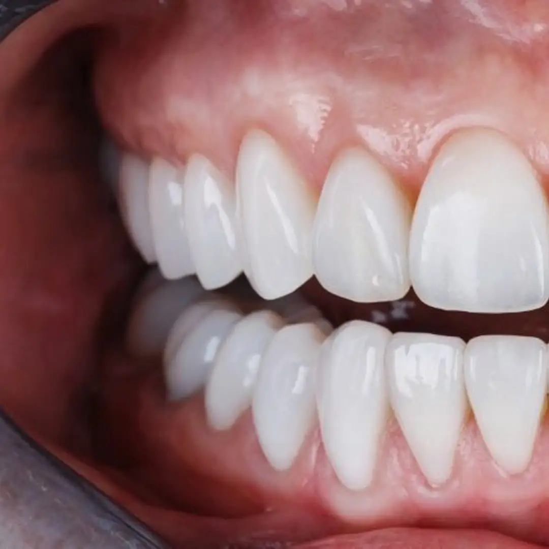 how-long-will-zirconia-crown