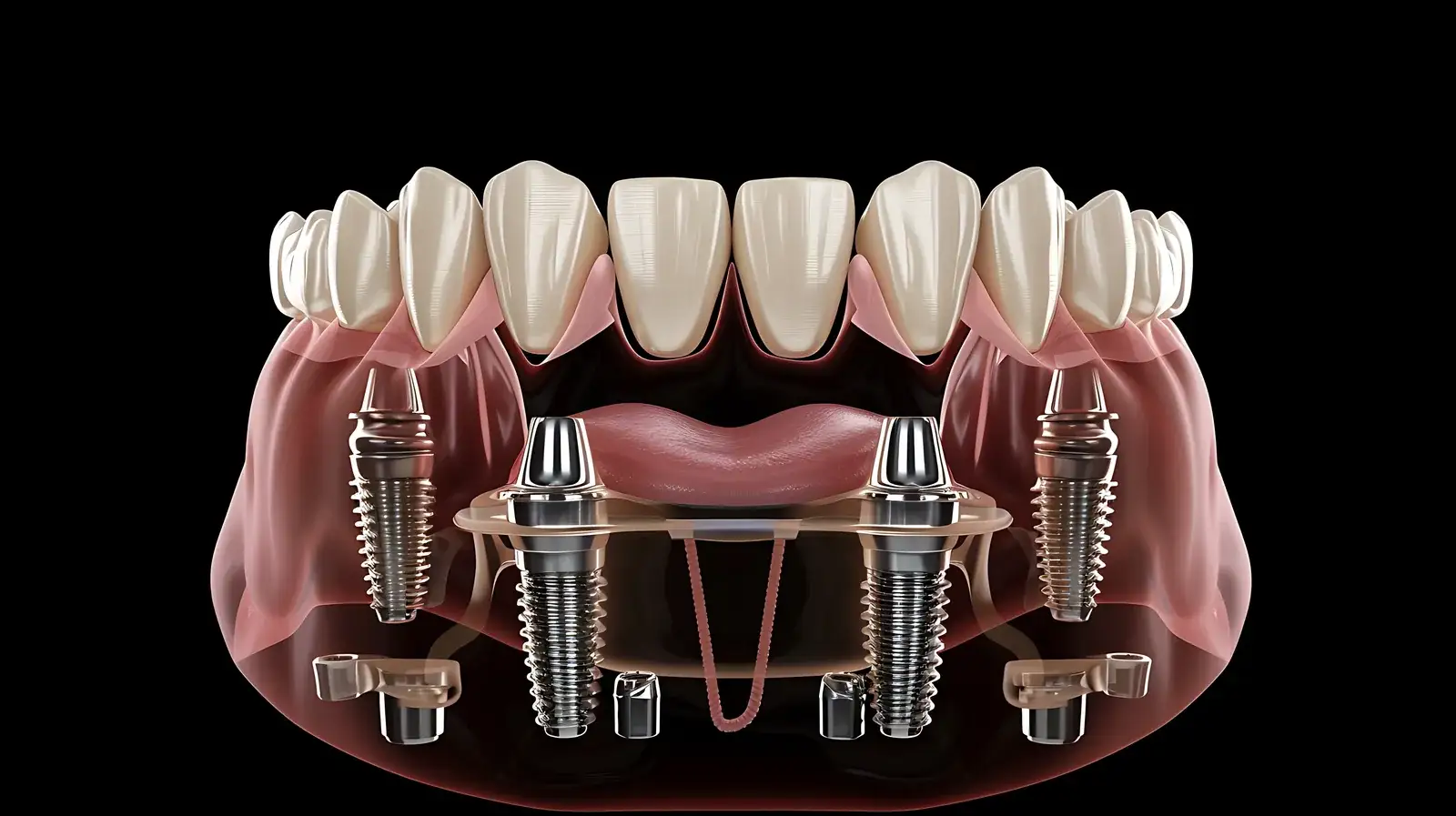 All-on-4 Dental Implants in Turkey: Full-Arch Cost and Process