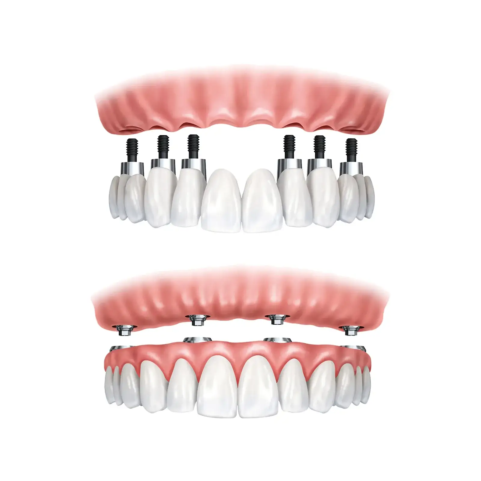 All-on-4 Dental Implants in Turkey: Cost, Procedure & Results