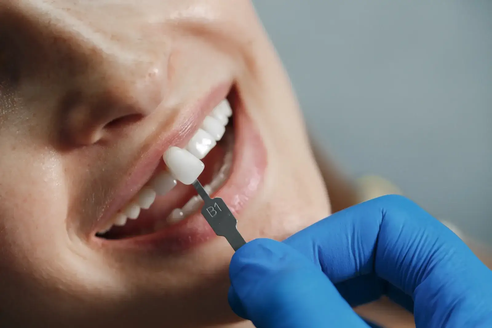 Dental Crowns Turkey: Cost and Types Compared