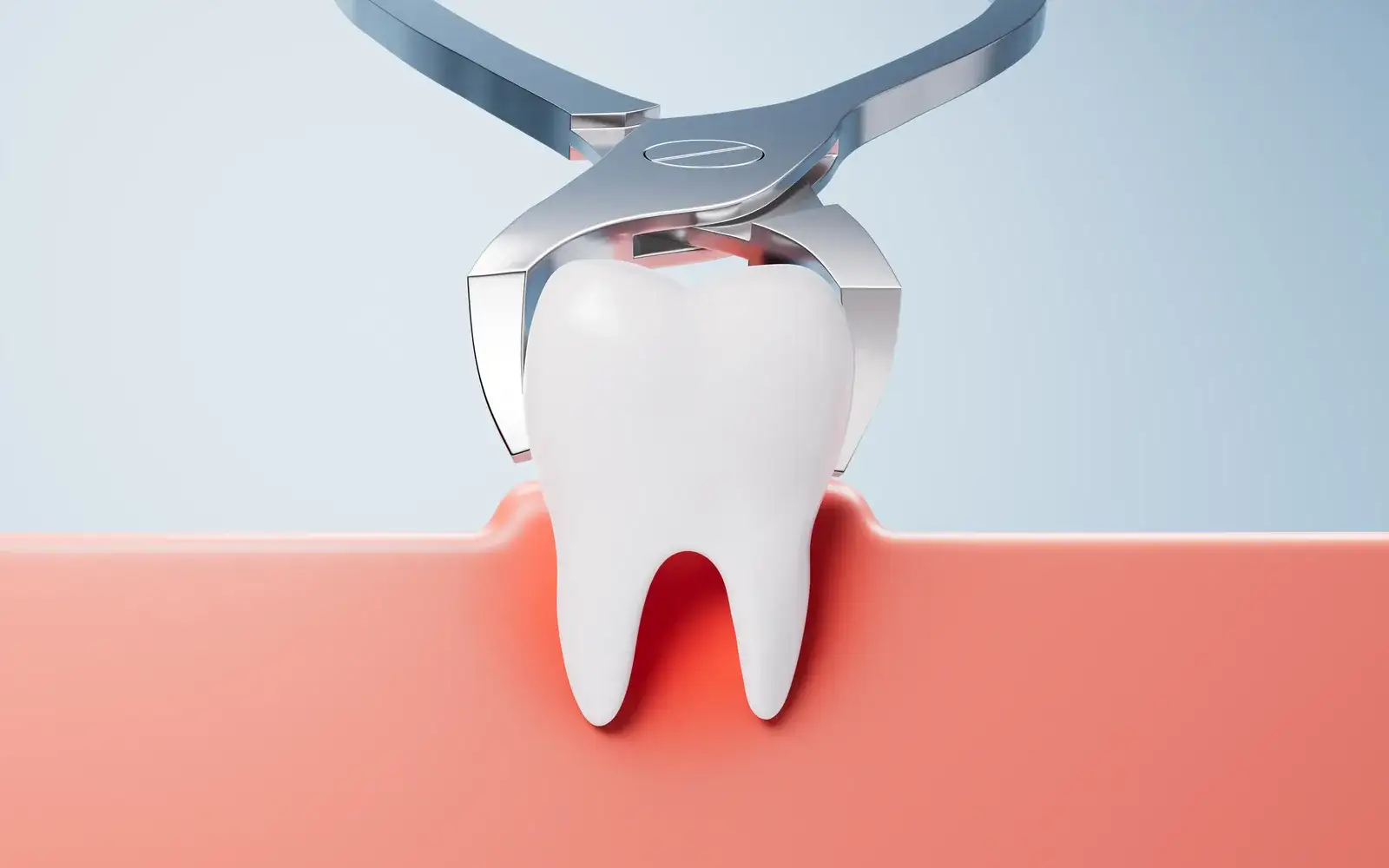 Wisdom Tooth Removal in Turkey: Cost, Recovery and Risks