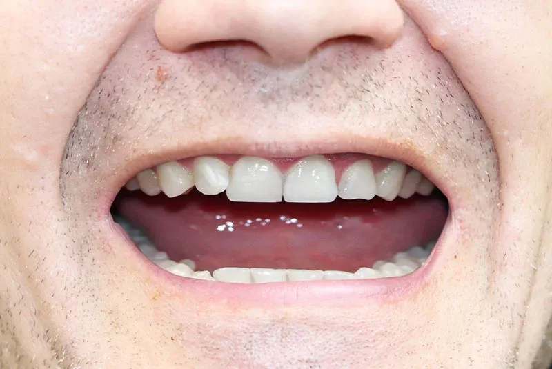 After Dental Implant Image in Turkey