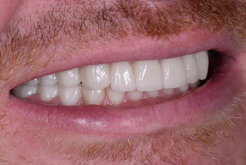 implant before image Istanbul Dental Clinic