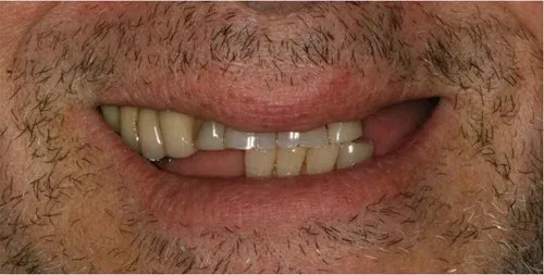 Before and After Dental Implant Image