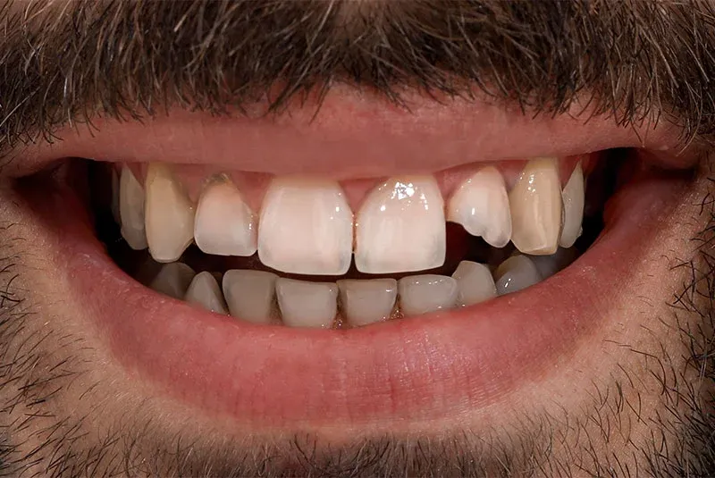 Before Dental Image at Istanbul Dental Clinic