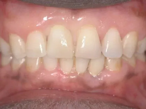 After Dental Implant in Turkey Image