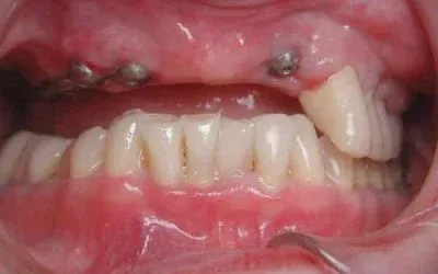 Before Image at Dental Implant