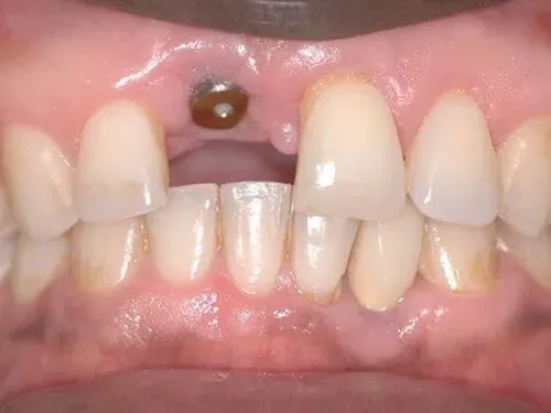 Before Image Dental Implant