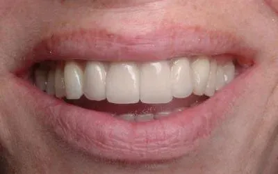 After Image Dental Implant Turkey