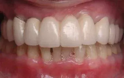 After Image at Istanbul Dental Clinic