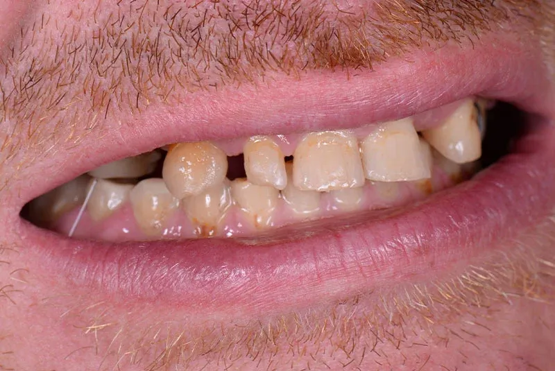 Before Dental Implant Image