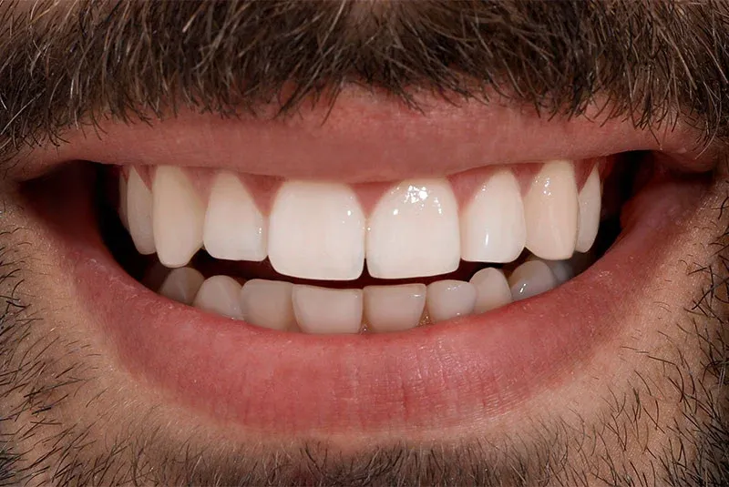 After Image Dental Implant