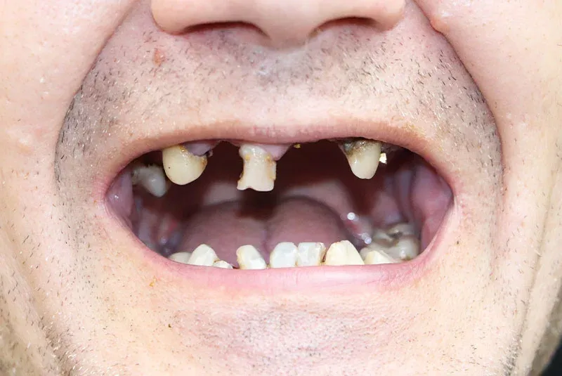 Before Dental Implant Image at Istanbul Dental Clinic
