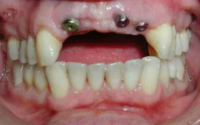 Before Image at Istanbul Dental Clinic