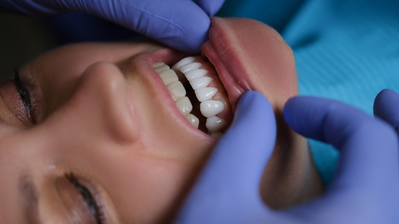 Best Pop-On Veneers- Top Clinical Picks
