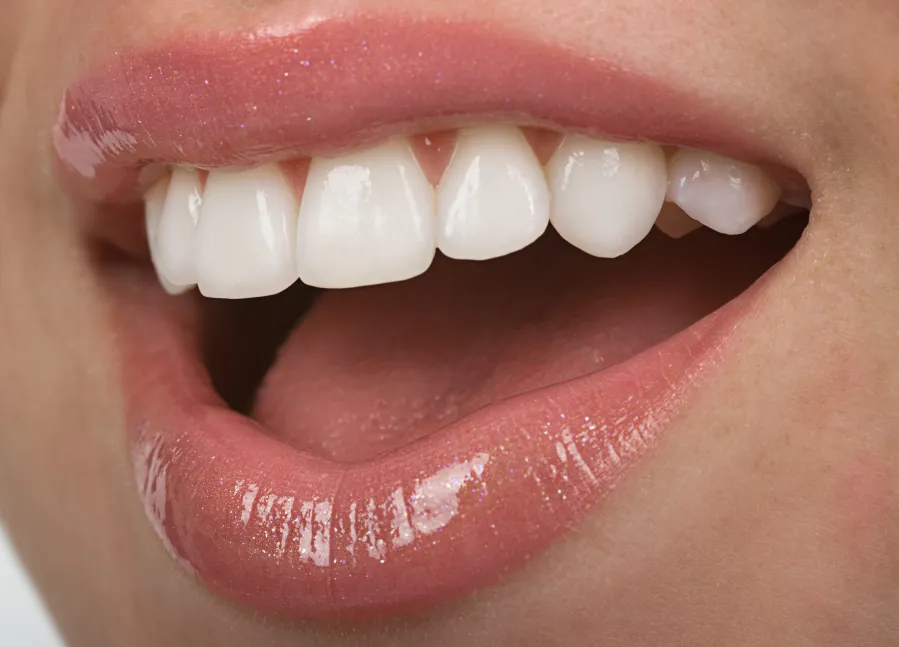 Best Pop-On Veneers