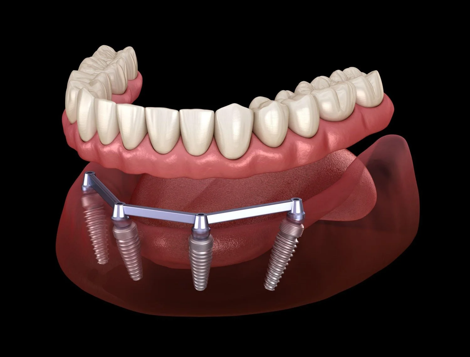 Dental implants in Turkey: titanium implant placed in the jawbone during treatment at Istanbul Care Dental