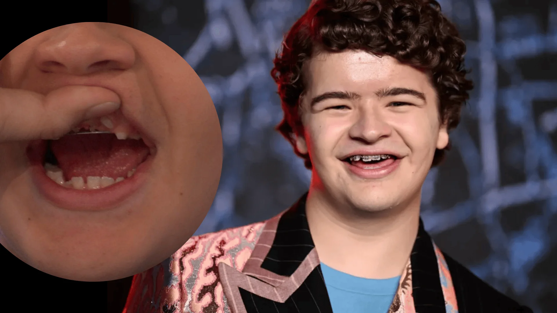 Gaten Matarazzo Teeth