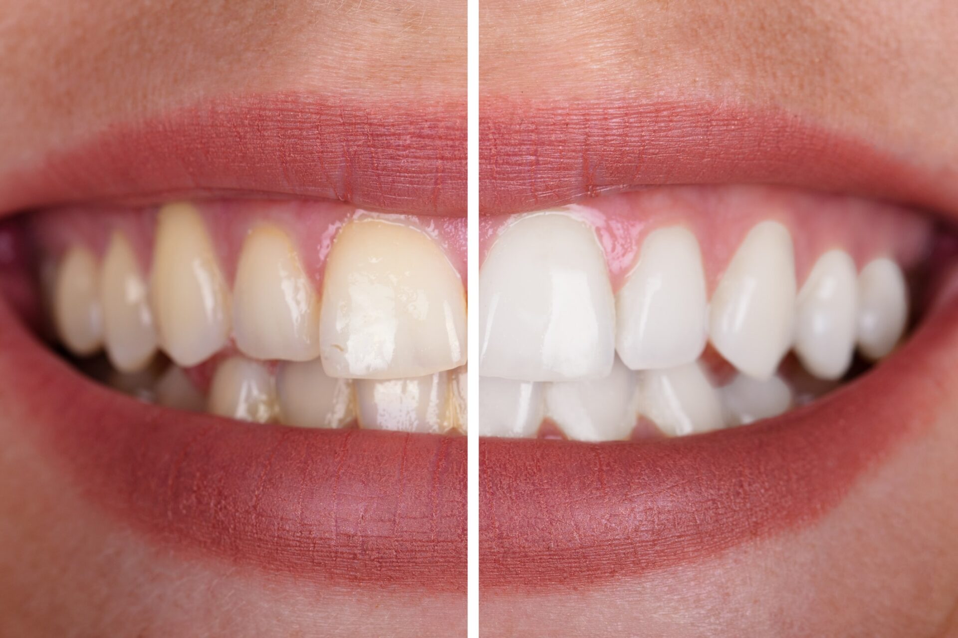 How to Whiten Teeth- Evidence-Based Methods