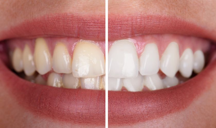 Professional Guide to Whitening Teeth at Home
