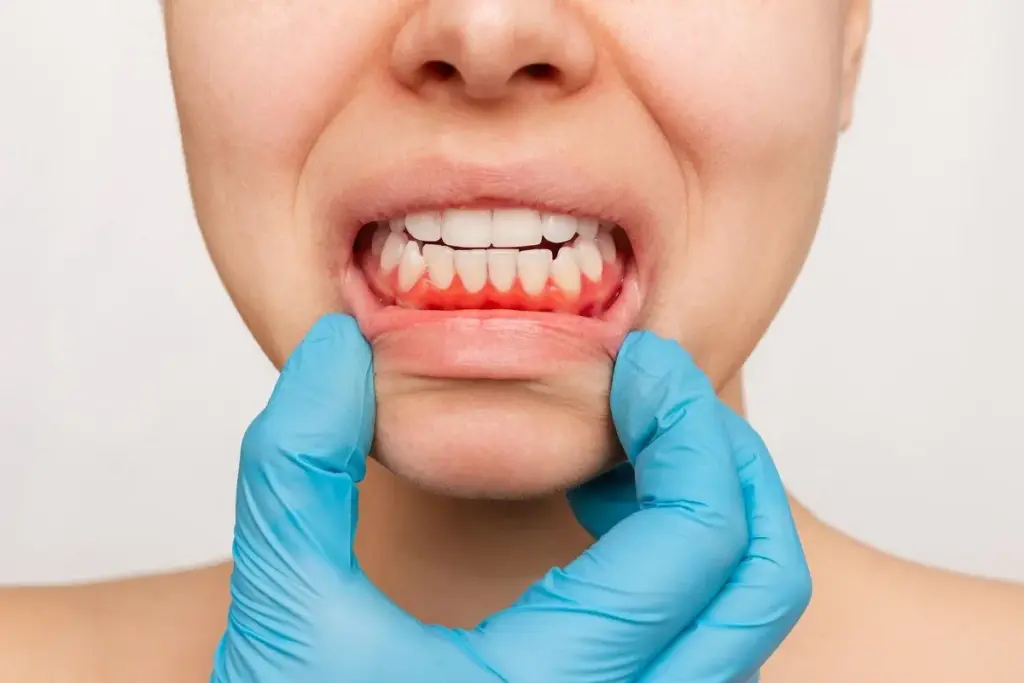 Red Spot on Gums