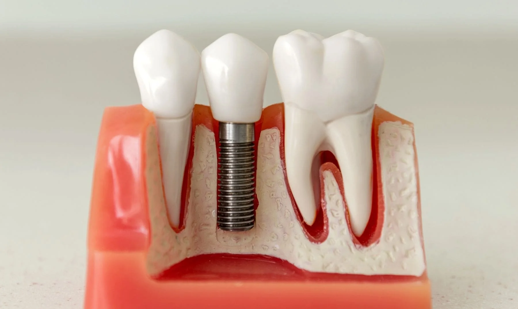 Cross-section model showing a dental implant screw set in the jawbone beside natural teeth