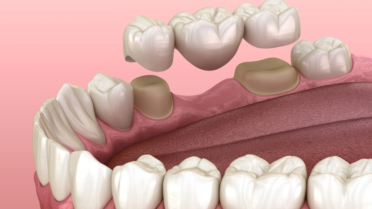 Tooth Bridge Types